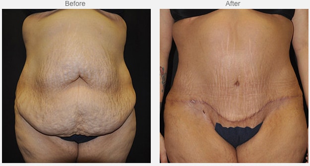 female patient’s bare stomach before and after post-weight loss surgery, stomach much flatter after procedure