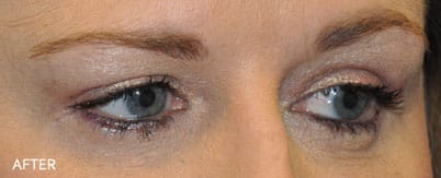 blepharoplasty after 1 1