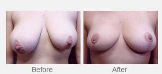 woman’s bare chest before and after breast asymmetry correction, breasts more even after procedure