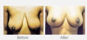 before and after breast reduction surgery photo