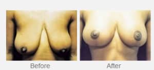 female patient’s chest before and after breast reduction, breasts smaller and lifted after procedure