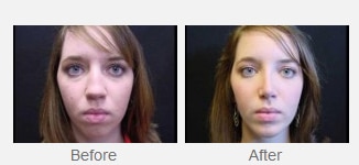 female patient before and after chin implant, chin more defined after procedure