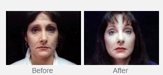 before and after headshot photo of older woman's face after procedure