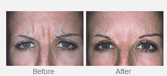 woman's forehead before and after botox treatment, with much smoother skin after injection