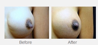 nipple correction gallery button