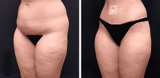 Thigh Lift before and after