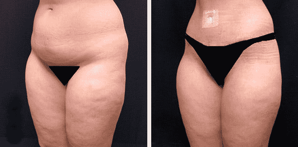 Are Inner Thighs Lifts Worth The Cost, Los Angeles? It's About