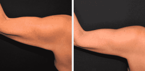 Before and after brachioplasty