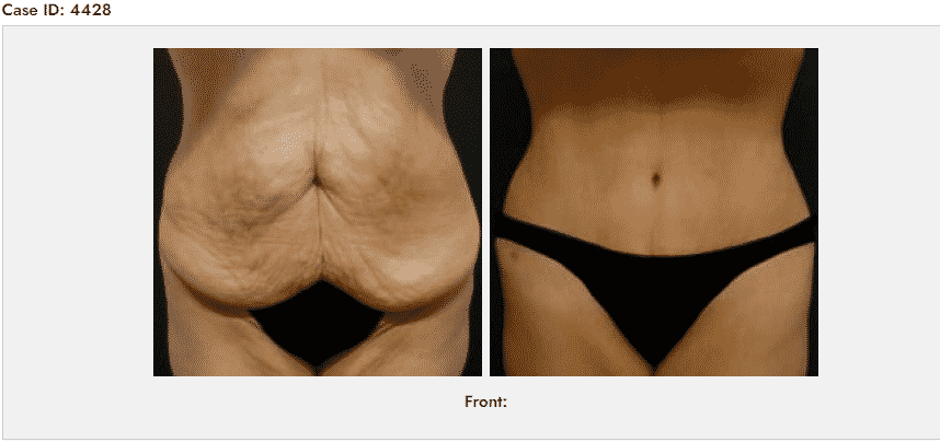 Abdominoplasty Before & After Photos - 1