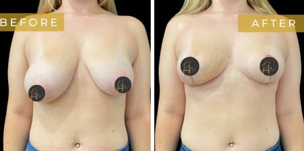 28553 Breast Asymmetry before and after