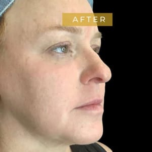 woman after profound rf skin treatment