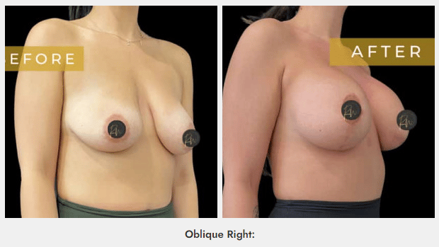 FireShot Capture 070 Case 6315 – Breast Lift with Breast Augmentation Case 6315 Rachel www.cosmeticsurgerydallas.com