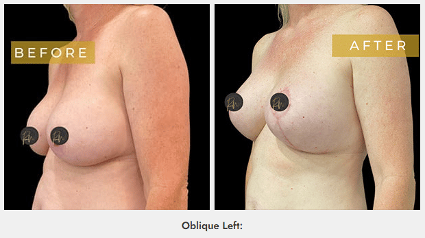 FireShot Capture 071 Case 6206 – Breast Lift with Breast Augmentation Case 6206 Rachel www.cosmeticsurgerydallas.com