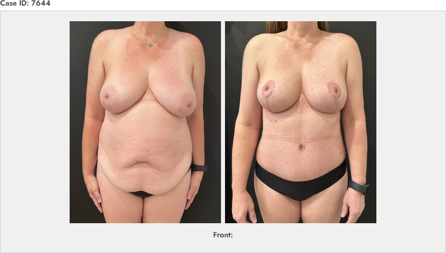 topless female patient before and after mommy makeover including tummy tuck, stomach much smaller after procedure