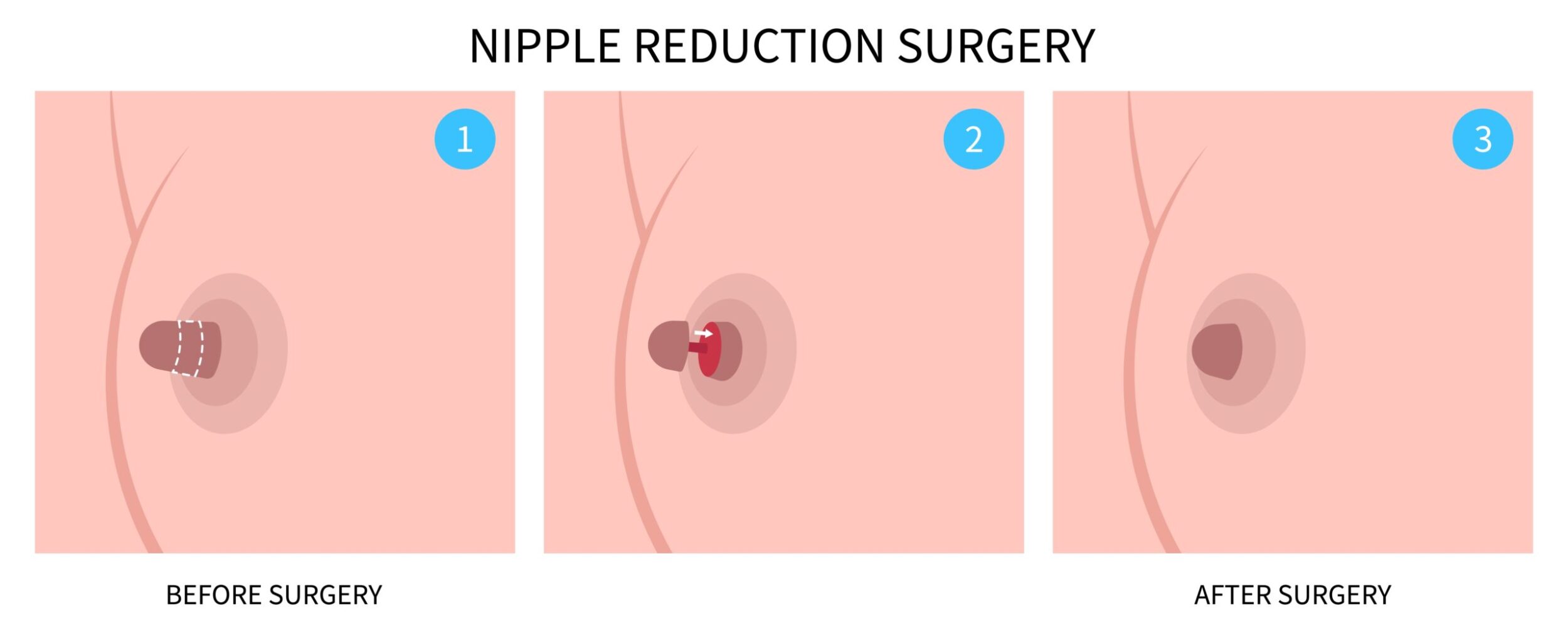 Diagram of nipple reduction surgery in Dallas to create nipples that are more proportional to breast size and shape.