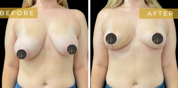 Before and After image of Breast Asymmetry Correction Texas