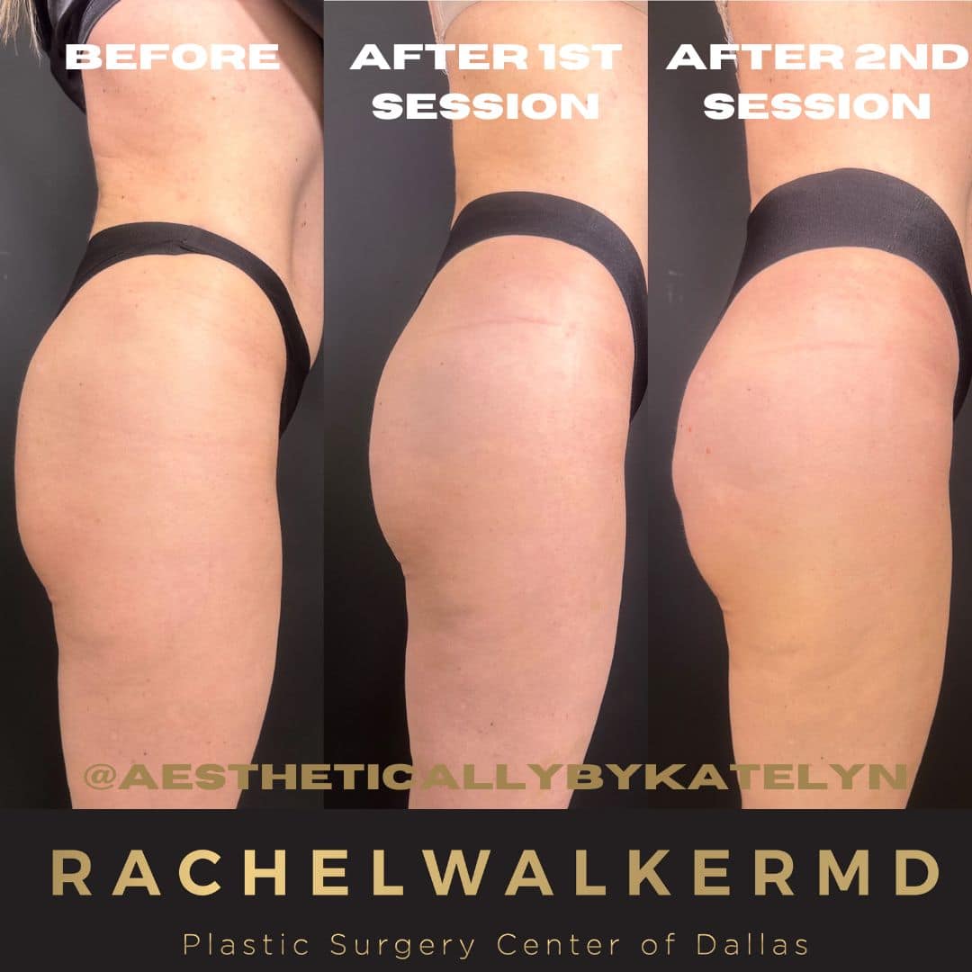 before and after image of Brazilian Butt Lift Dallas TX