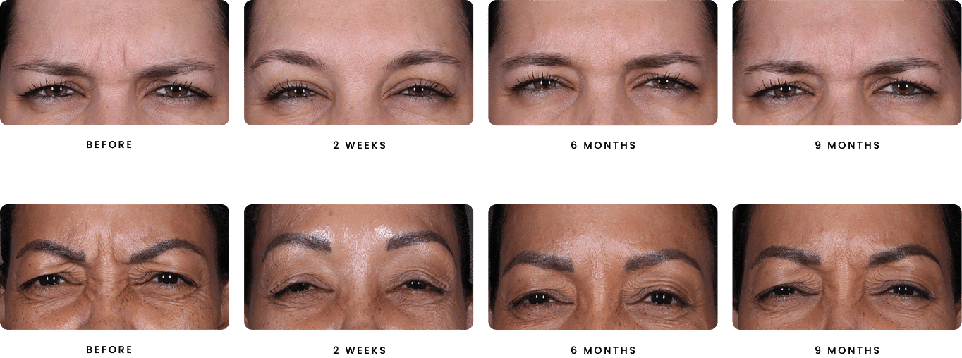 Before and After Image of Daxxify Dallas TX