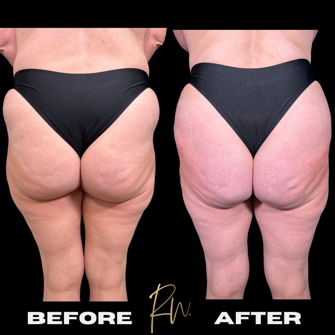 before and after image of Non-Surgical BBL Dallas TX