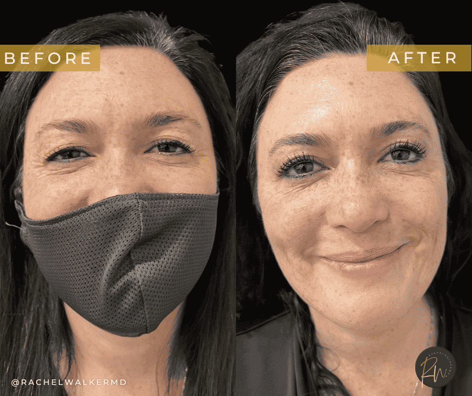 Before and After image of Blepharoplasty Texas