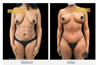 Before and After image of Mommy Makeover Dallas TX
