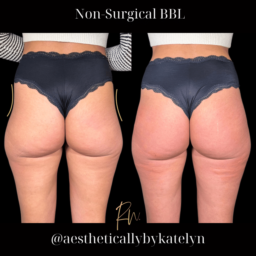 before and after image of Radiesse Brazilian Butt Lift Dallas TX