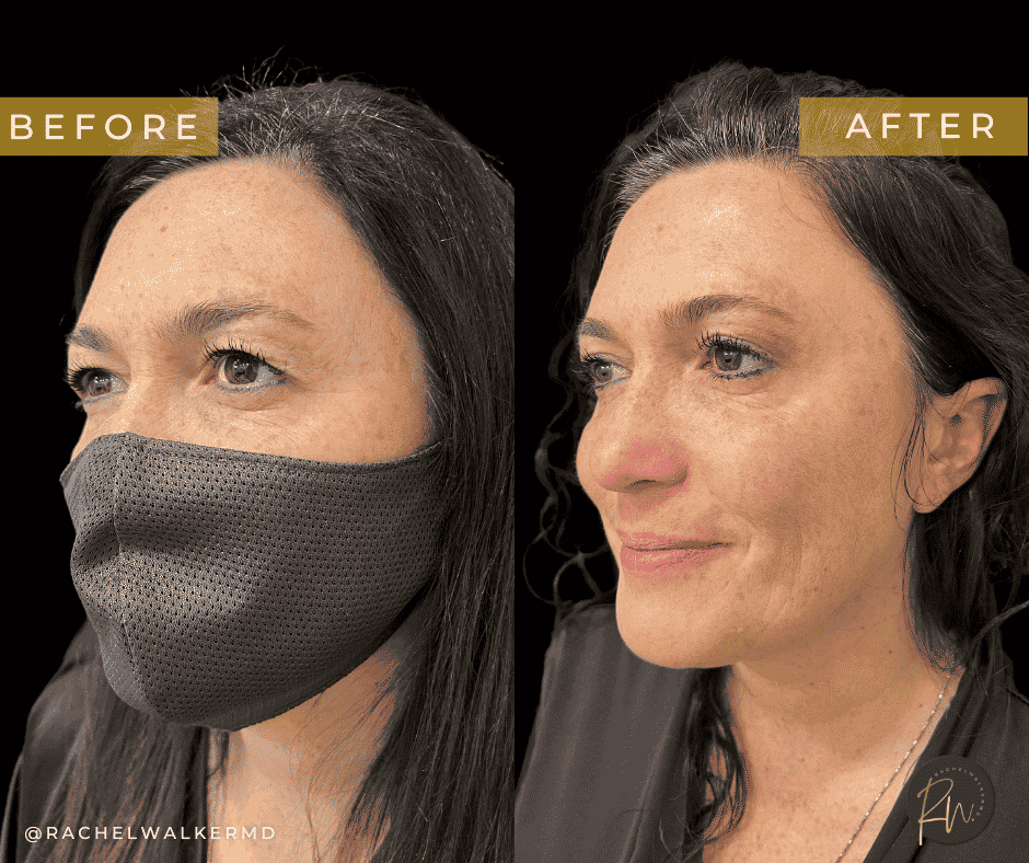 Before and After image of Eyelid Surgery Dallas TX