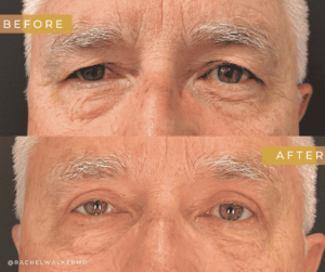 Before and After image of Blepharoplasty Dallas TX