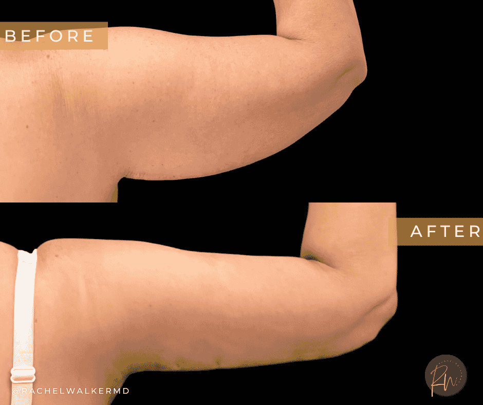 Before and After image of Brachioplasty Dallas TX