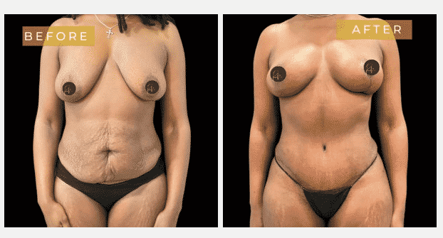 Before and After Image of Tummy Tuck Dallas TX