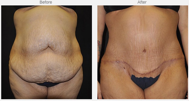 before and after image of Post-Massive Weight Loss Surgery Dallas TX