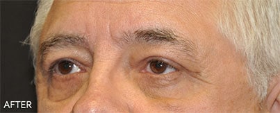 After Blepharoplasty Dallas TX