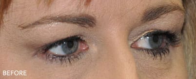 Before Eyelid Surgery Dallas TX