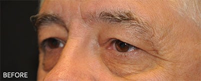 Before Blepharoplasty Dallas TX