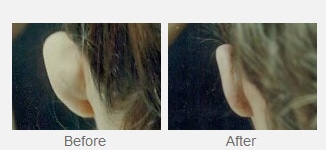 Before and After Image of Ear Surgery Dallas TX
