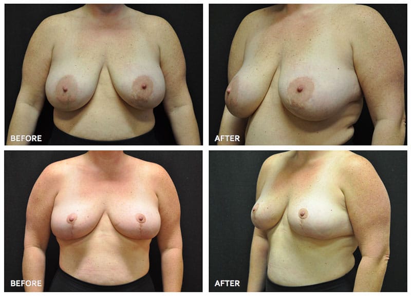 Before and After Image of Mastopexy Dallas TX