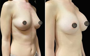 Before and After image of Breast Augmentation Dallas TX