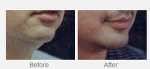 Before and After Image of SAFELipo Dallas TX