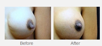 Before and After image of Nipple Reduction Dallas TX