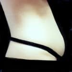 Before Liposuction Dallas TX