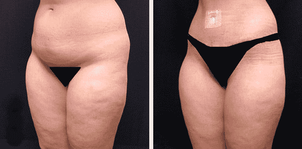 Before and After image of Thigh Lift Dallas TX