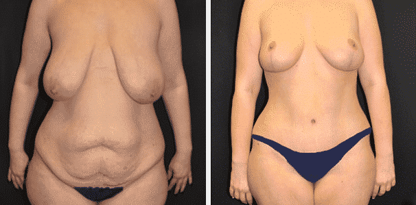 Before and After image of Mommy Makeover Texas