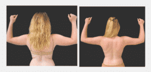 Before and After Image of Liposuction Dallas TX