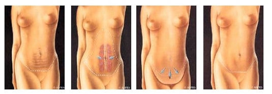 Tummy Tuck Dallas TX