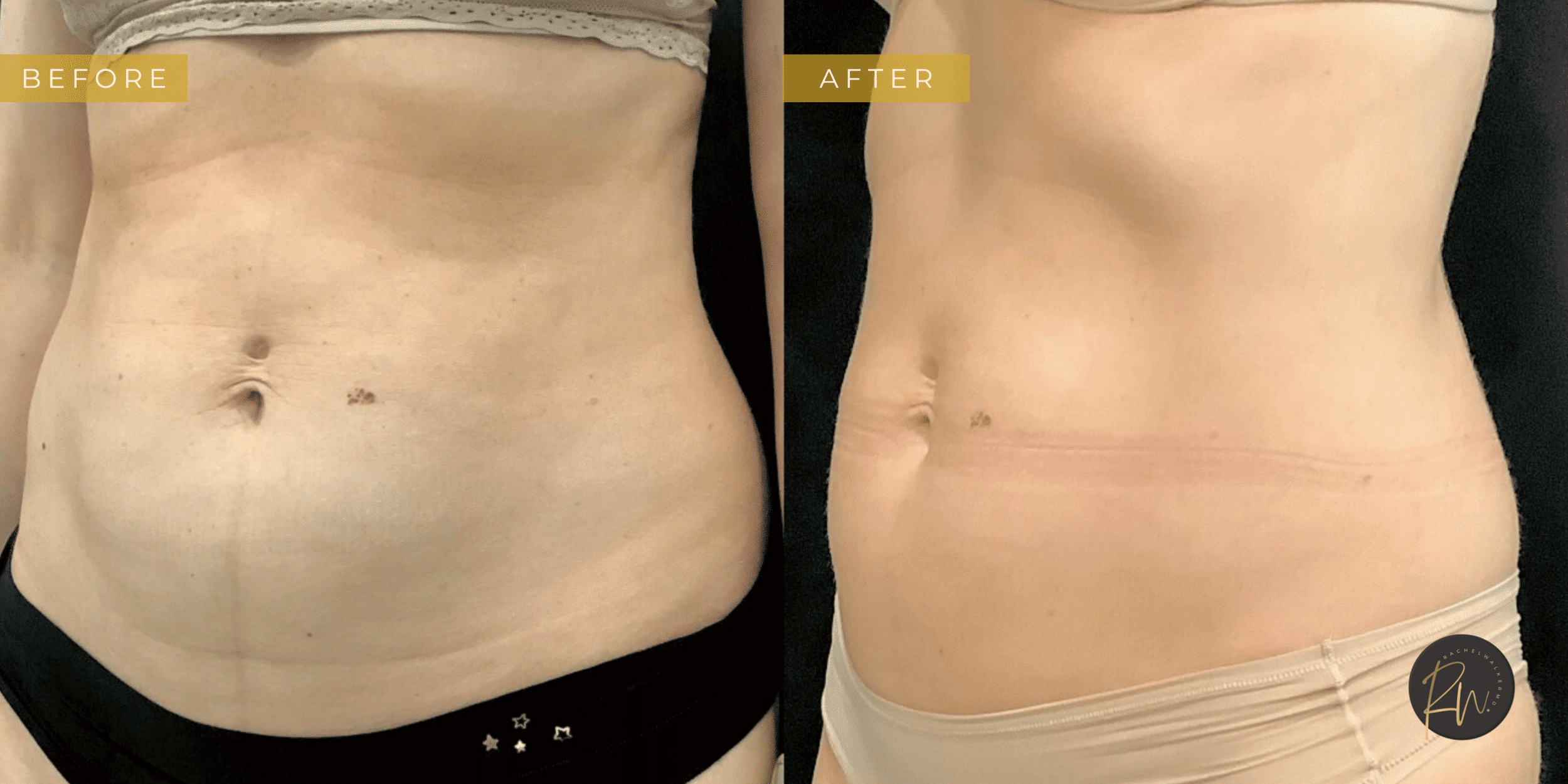 before and after image of Emsculpt Neo Dallas TX
