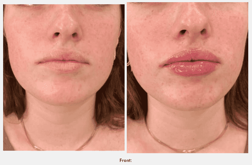 Before and After image of Hyaluronic Acid Fillers Texas