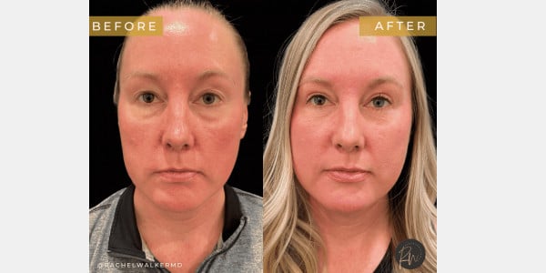 Before and After Image of Facial Plastic Surgery Texas