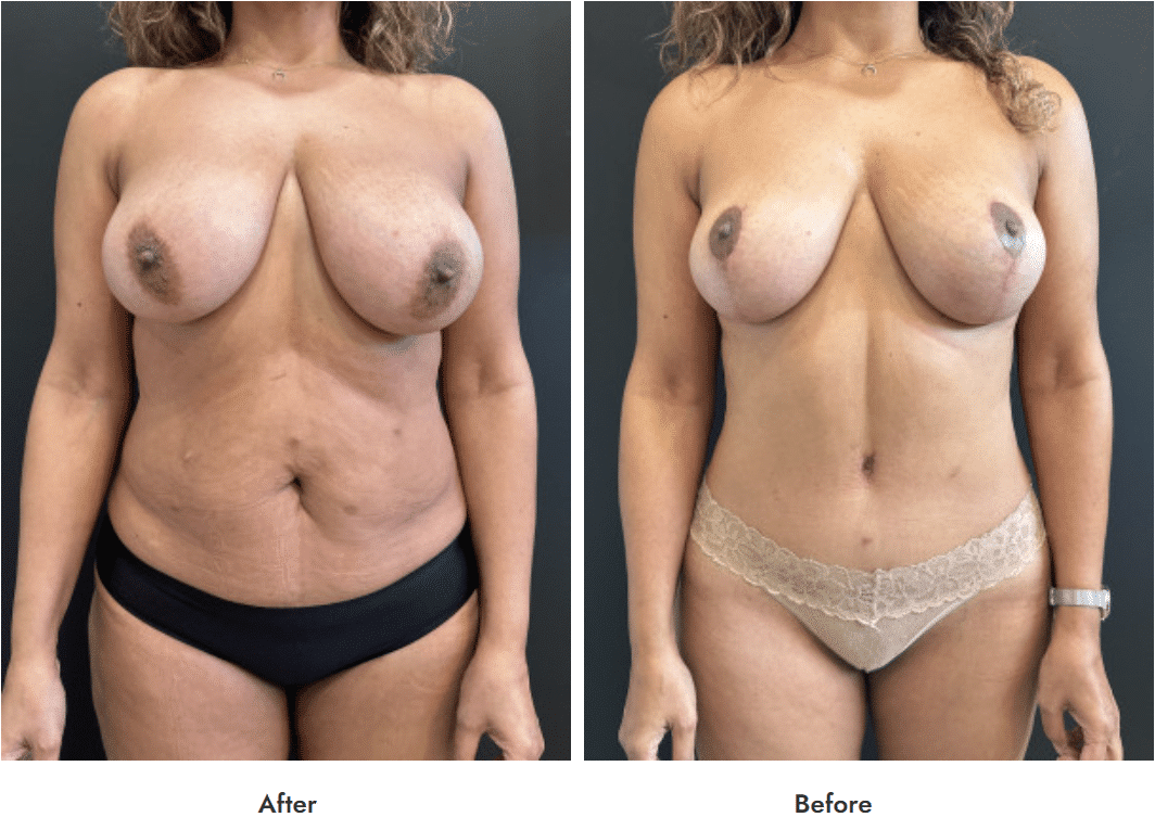 Before and After image of Breast Lift with Breast Augmentation Texas