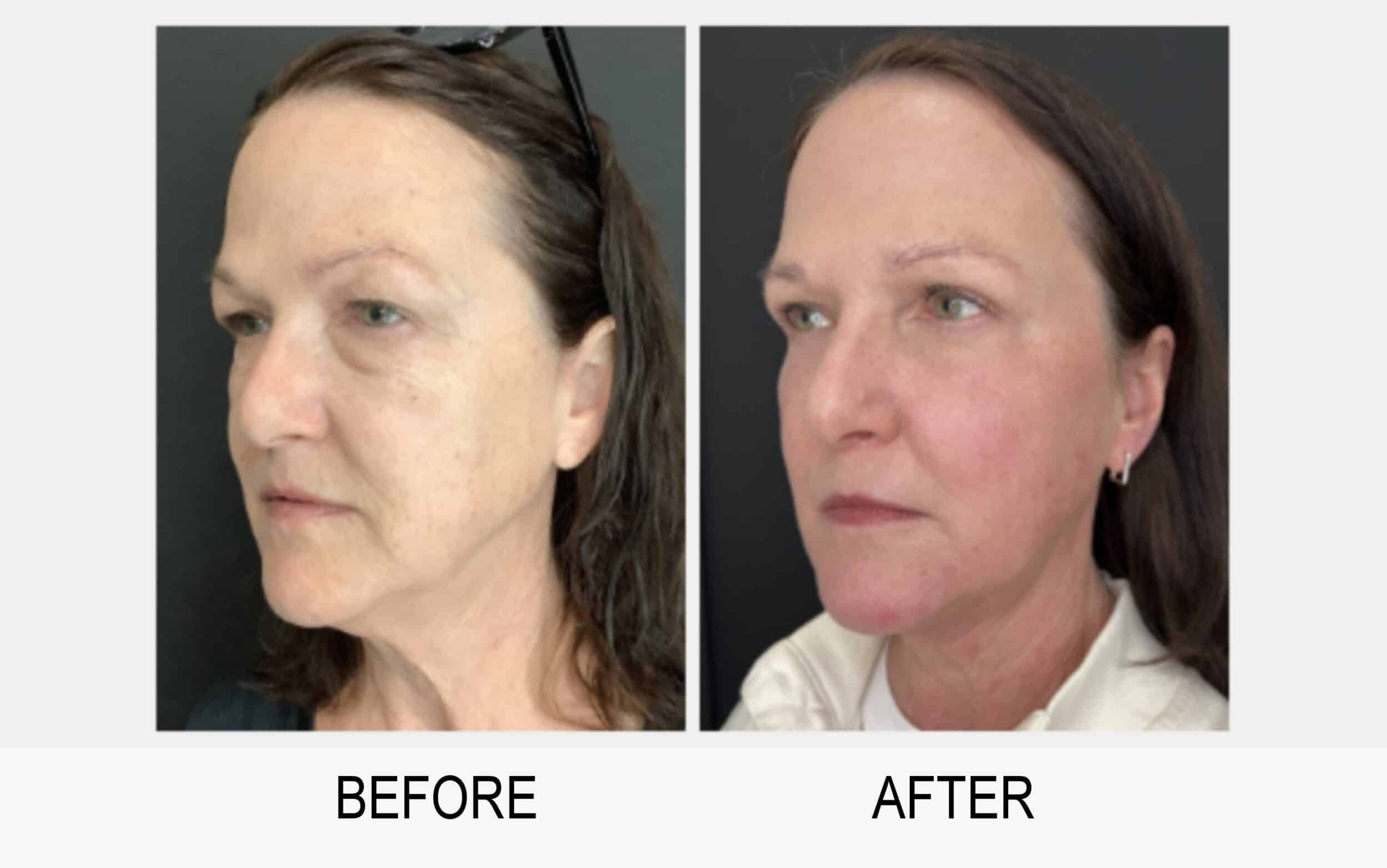 Before and After Image of Facial Plastic Surgery Dallas TX