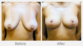 Before and After Image of Breast Lift Dallas TX